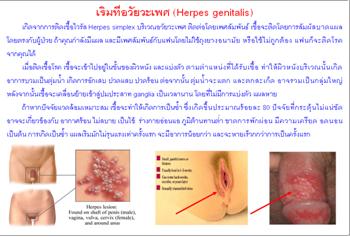 ใบความรู้ 15 เริมที่อวัยวะเพศ.JPG